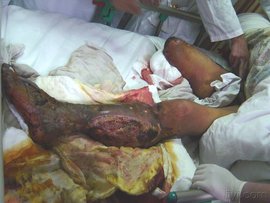 骨折晚期合并症