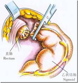 结肠直肠切除肛门外吻合术