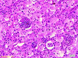 炎症性单形性未分化肉瘤