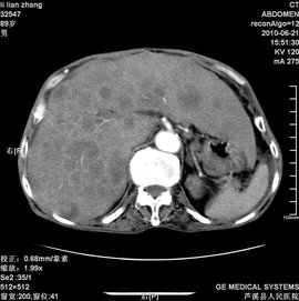 肝弥漫性病变_360百科