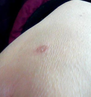 两岁小孩被烫水烫伤脱皮了,用凉水冲了一分钟