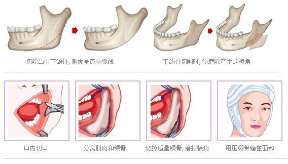谁做过下颌骨整形,进来说说, 做的时候痛不,整个