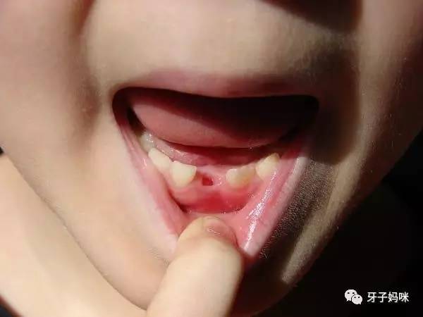 这两种药一起用会死+小孩掉落的乳牙别丢:可救自己一命 - 满园春色 - 满园春色 医生呼吁小孩掉落的乳牙别再丢掉,必要时可救自己一命! - 武汉老徐 - 武汉老徐的博客