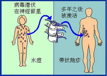 水痘-帶狀皰疹病毒為本病的致病病原體,侵犯兒童可引起水痘,在成年人